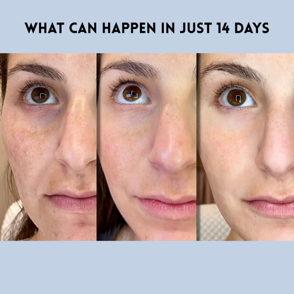 YouthLift Renew Strips – The Instant Solution for Timeless Beauty + 50% OFF