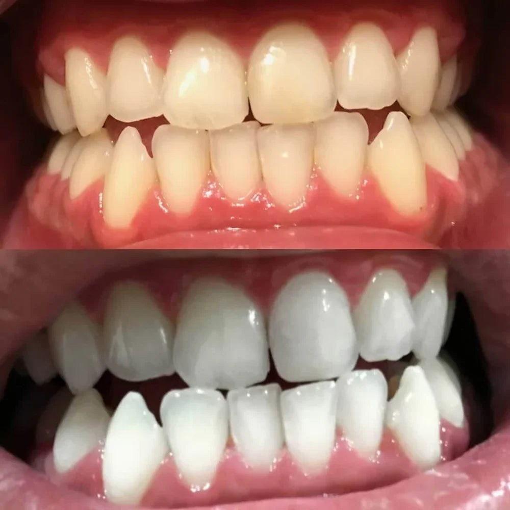 Teeth Whitening Pen - Radiant smile in 10 minutes