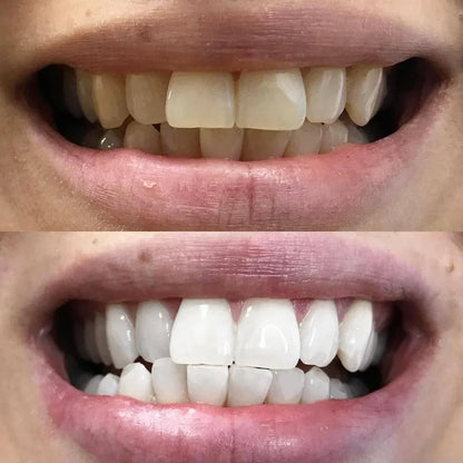 Teeth Whitening Pen - Radiant smile in 10 minutes